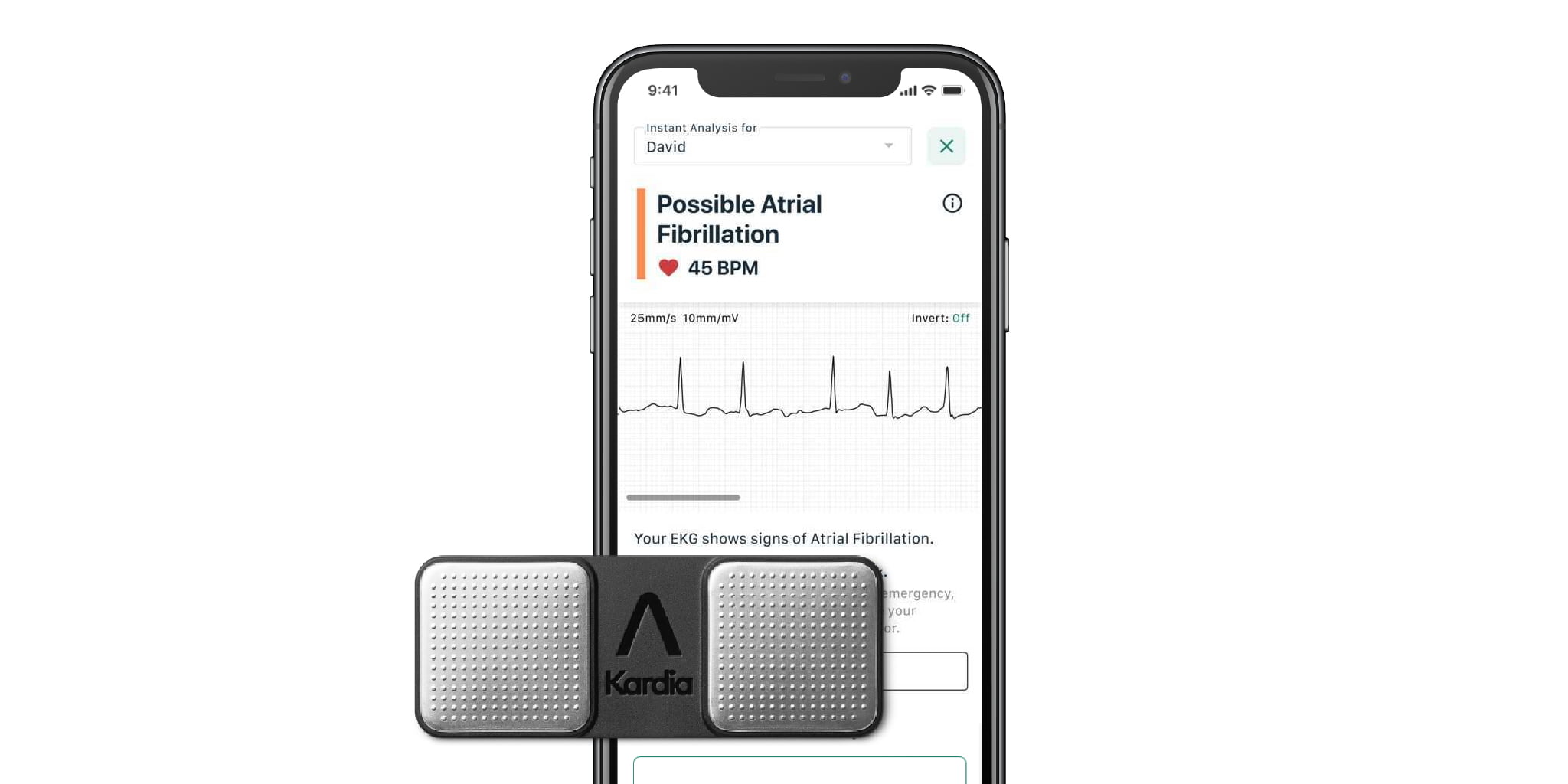 KardiaMobile and Kardia Instant Analysis showing Possible Atrial Fibrillation